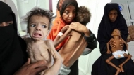 اليونيسف: 11 مليون طفل في اليمن بحاجة إلى مساعدات